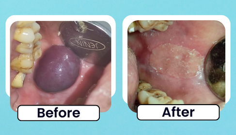 Before and After clinical photo of oral soft tissue lesion management